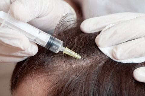 Активное лечение алопеции (выпадения волос) 